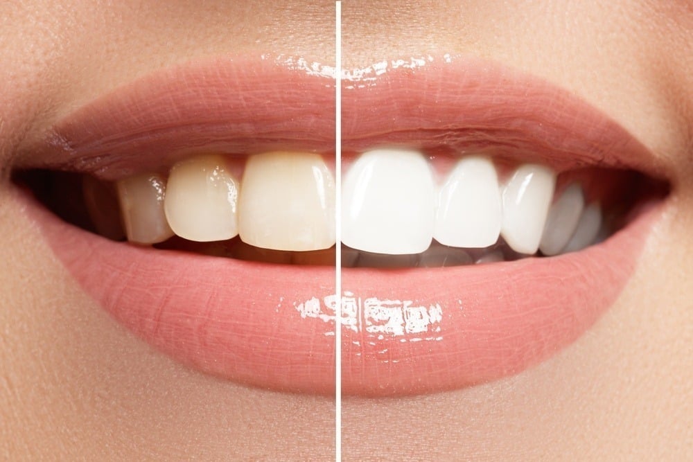 How-Many-Teeth-Whitening-Sessions-Do-You-Need